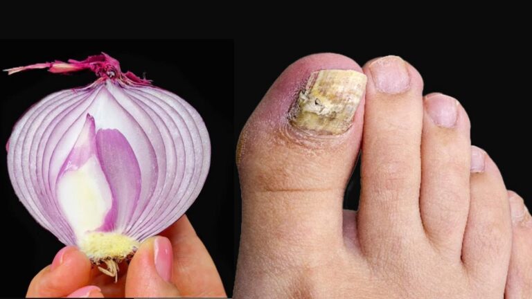 Ein alter Trick entfernt Nagelpilz schnell und natürlich – Sie werden staunen …