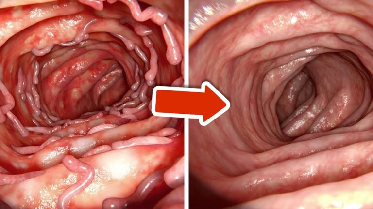 5 schnelle Methoden zur natürlichen Reinigung deines Dickdarms entdecken!