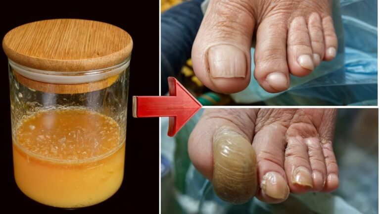 5 einfache Hausmittel gegen Nagelpilz für schöne, gesunde Nägel!